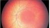 Что такое застойный диск зрительного нерва